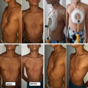 Órtese Bomba de Vácuo para Sucção de Pectus Excavatum